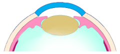 加齢性の白内障について