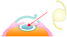 白内障手術について