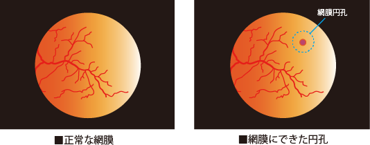 網膜 円 孔 と は