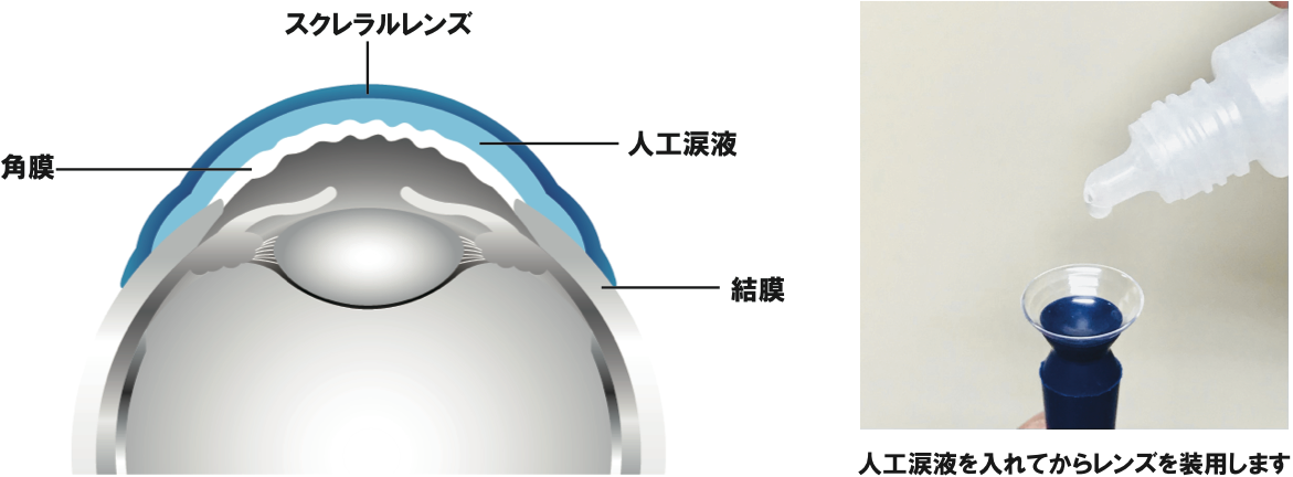 ensui_img_37 円錐角膜専用のハードコンタクトレンズによる視力矯正