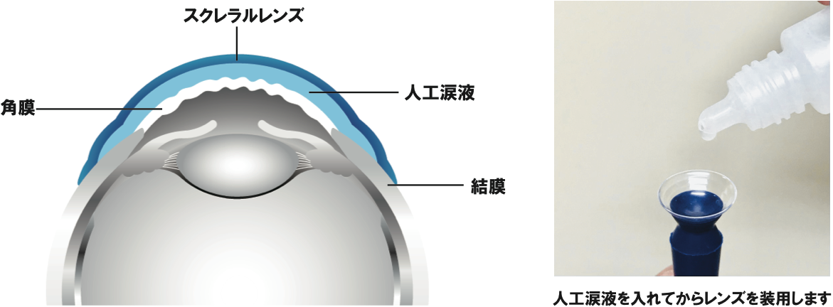 円錐角膜専用のハードコンタクトレンズによる視力矯正