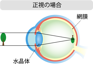 正視の屈折