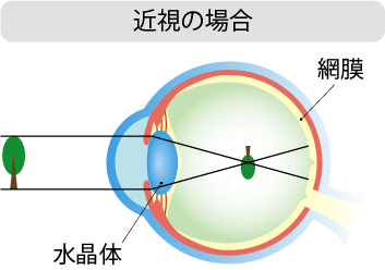 近視の屈折