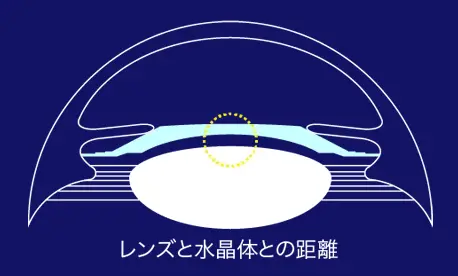 レンズと水晶体との距離