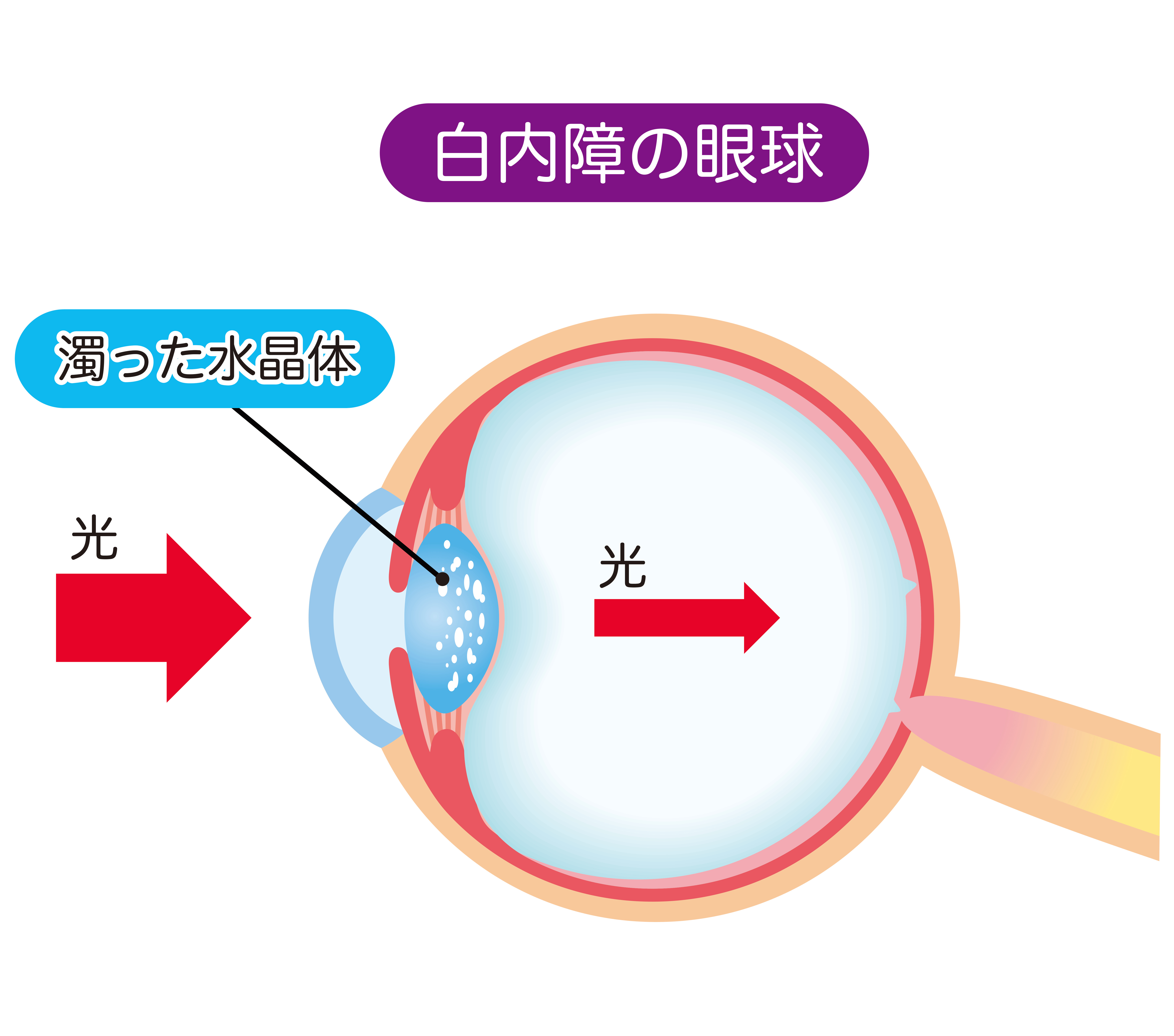 白内障により濁った水晶体について