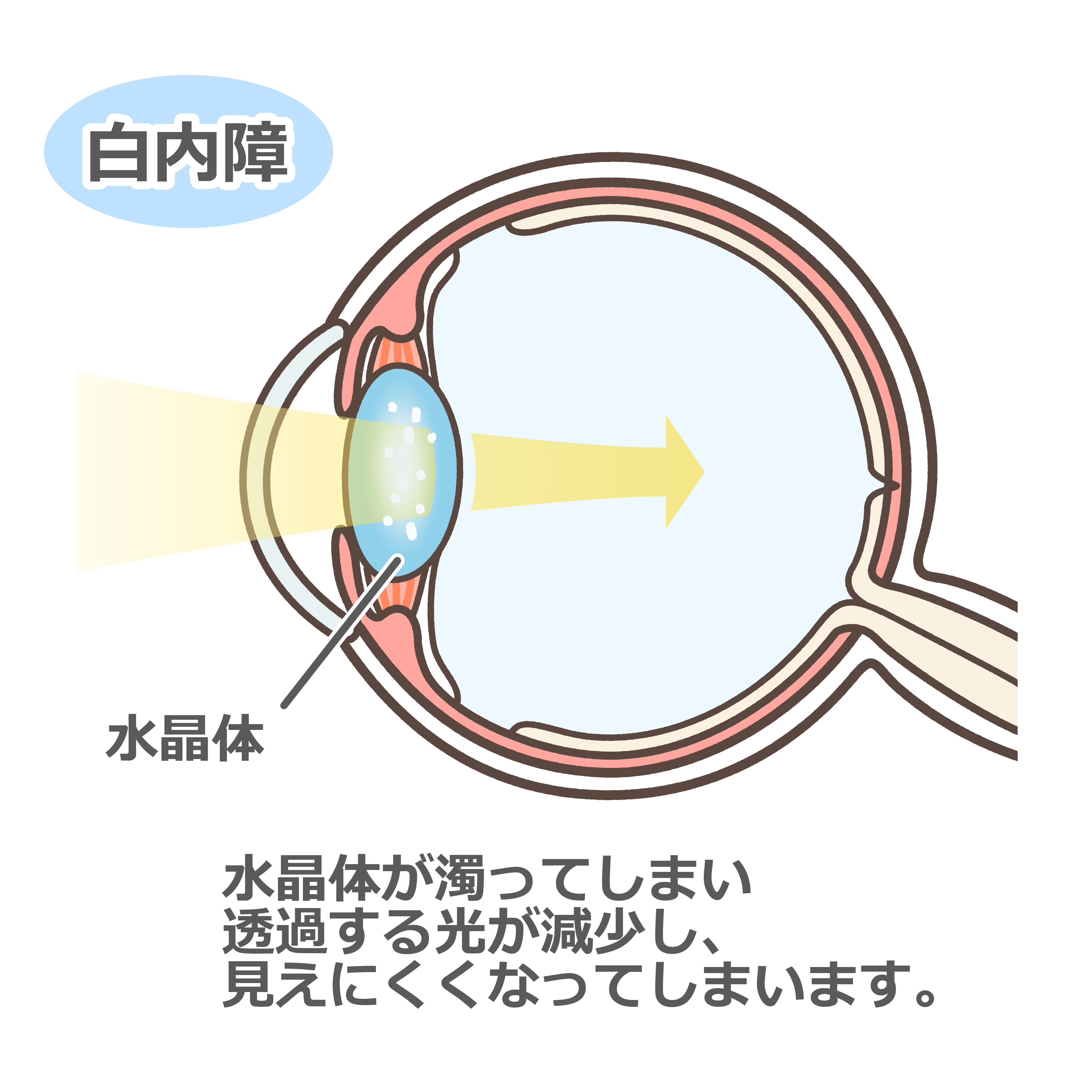 白内障について