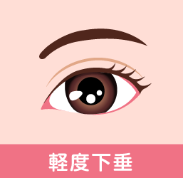 眼瞼下垂の症状 軽度下垂
